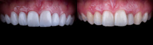 dental veneers